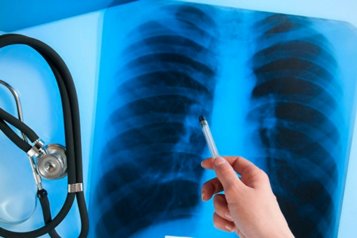 На Черкащині захворюваність на туберкульоз на 46% вища за середній рівень по країні